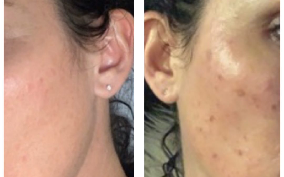 All you need to know about Sun Damage and Photo Rejuvenation.