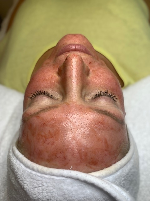 All you need to know about Micro-Needling.