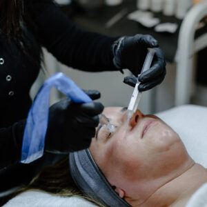 MicroNeedling Abdomen