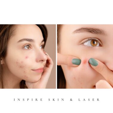 Struggling with Acne? We have a few tips for you!