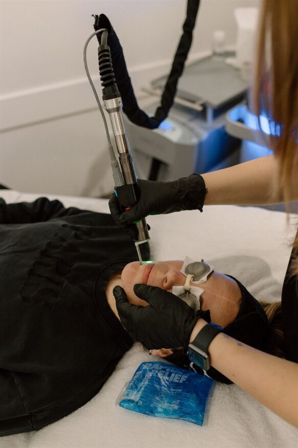 Photo Rejuvenation Spot Treatment